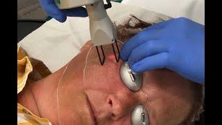 DEKA Smartxide Laser Cold Peel Bristol