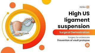 High Utero-sacral Ligament Suspension (HULS) | Abdominal approach