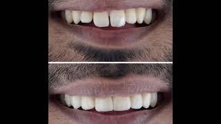 Veneers| Best Dental| Smile change| Smile Makeover| We Dental| Dr Arshad| E max| New Smile| Cbe