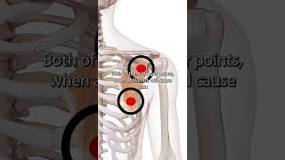 Pectoralis Minor Trigger Points