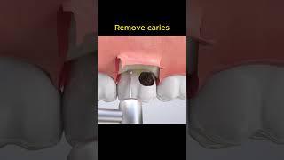 How to remove caries?