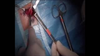 Inguinal Point Pelvic leak and varices