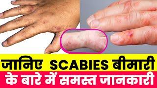 जानिए  Scabies बीमारी के बारे में समस्त जानकारी Dr Ajay Jain