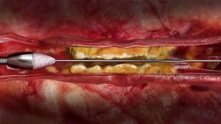 Rotational Atherectomy for Peripheral Artery Disease | CardioVisual