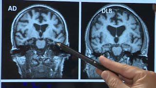 Researchers work to understand how COVID-19 impacts memory loss