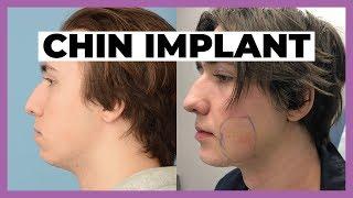 Cosmetic Surgery Patient Experience - Chin Implant