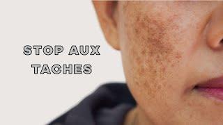 COMMENT TRAITER ET PREVENIR LES TACHES ET LE MELASMA EN ETE