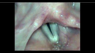 Right Vocal Cord Palsy Causing Hoarse Voice