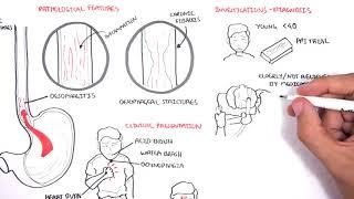 GORD (GERD) Gastro Oesophageal Reflux Disease  - Overview pathophysiology, treatment