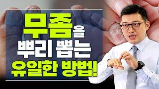 무좀은 왜 자꾸 재발할까? 무좀으로 고생중이라면 꼭 봐야 할 영상!  - 고제익의 비아그라보다 달리기 #39