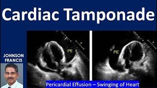 Cardiac Tamponade