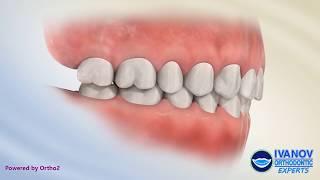 What is Normal Teeth and Bite Occlusion