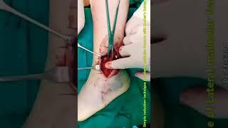 S5.Lateral malleolar fracture reduction technique, using with Kocher clamp (for Non-osteoporosis)