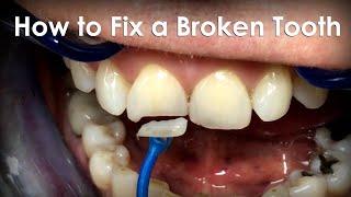 How to Fix a Broken Tooth Using Monolithic Press