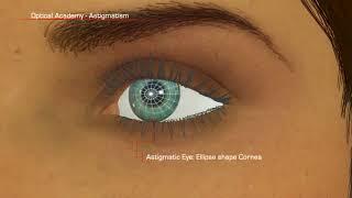 Shamir Optical Academy Astigmatism