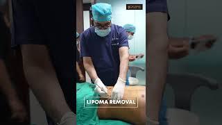 Lipoma cure | Multiple Lipoma removal #shorts