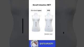 Minimally Invasive/Laparoscopic Surgery for Small Intestine Neuroendocrine Tumors: A Viable Option!