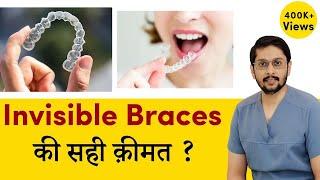 Invisible braces (dental aligners) ki sahi price | Cost of aligners in Indore ?