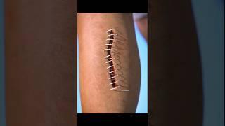how stitches works on skin || #shorts #hindi #science