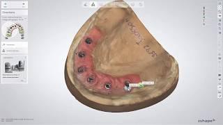 3Shape Dental System - Full Anatomy Zirconia Bridge on Implants with Gums