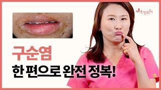 구순염 완전정복! 구순염 탈출 생활관리 TIP