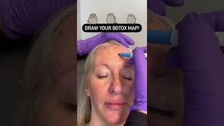 Draw Your Botox Map