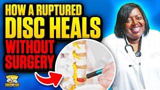 How A Ruptured Disc Heals Without Surgery: Natural Recovery Tips