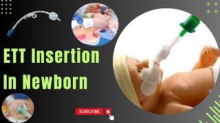 Neonatal Endotracheal Intubation | Endotracheal Intubation in Newborns | ETT insertion in an Infant