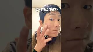 여드름 흉터 치료 11시간 후..