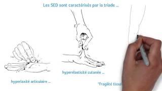 Syndromes d'Ehlers-Danlos : Qu'est-ce que c'est ?