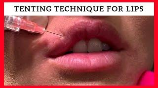 Tenting Technique for Lip Enhancement by Dr. Steven F Weiner