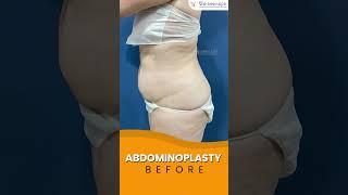 Abdominoplasty Surgery (⭕) Live Procedure Results | Remove Excessive Fat | The Aesculpir Clinic