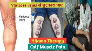 Varicose veins treatment by Hijama therapy (Wet Cupping) / Calf Muscle pain / Spider veins therapy