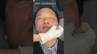 Microneedling Before And After | DIY Microneedling at Home  #microneedling #mesotherapy #aesthetic