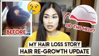 MY HAIR LOSS STORY (ALOPECIA AREATA)⎮iRestore LASER HAIR GROWTH SYSTEM 1-year UPDATE⎮BEFORE & AFTER