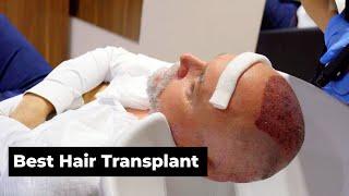 Best Hair Transplant Operation-2024