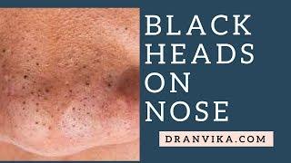 HOW TO TREAT BLACK HEADS ON NOSE BY DERMATOLOGIST :DR. ANVIKA