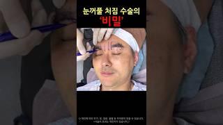 눈꺼풀처짐 때문에 고민이라고? #modsclinic #모즈클리닉 #눈썹하거상술 #눈꺼풀처짐