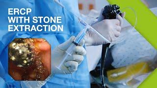 ERCP Practical Guide I Part 2: ERCP with Stone Extraction