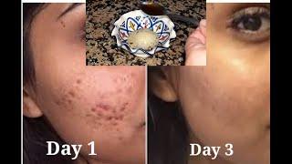 aspirin for acne before and after - how to get rid of acne in 3 days use #aspirin