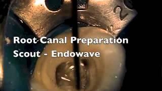 Improving Root canal Therapy