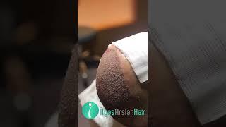 Best Result from Bald to Bold Hair Transplant #hair #hairtransplant #skincare #shorts #results