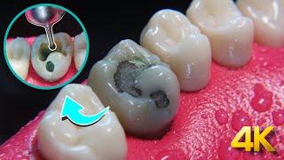 Teeth capping process