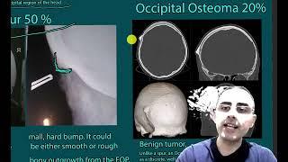 Hard, non-painful bump on the back of the head Possible causes