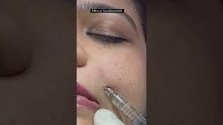 Derma Fillers in Ludhiana, Punjab, India By Dr Vikas Gawri