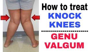 How to fix Knock knees/Genu valgum | Knock knees exercises at home  | Dr. Pratibha Singh (PT)