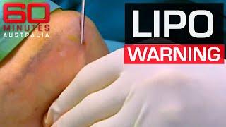 Early warning signs on potential dangers of cosmetic surgeries | 60 Minutes Australia