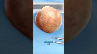 What causes a gallbladder attack? (3D Animation)