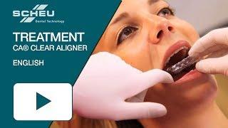 Katharinas successful CA® CLEAR ALIGNER treatment