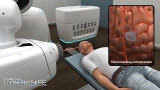 CyberKnife Brain Tumor Animation